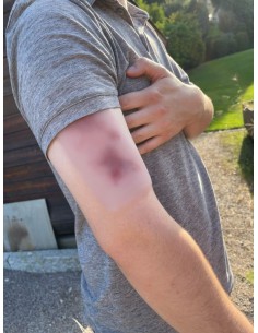 Fresh Hematoma Wound Moulage Erler Zimmer EZ-NW117