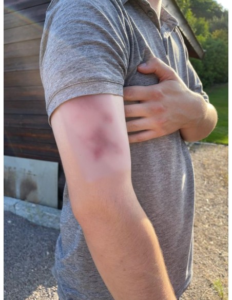 Erler Zimmer EZ-NW117 Moulage para heridas con hematoma fresco