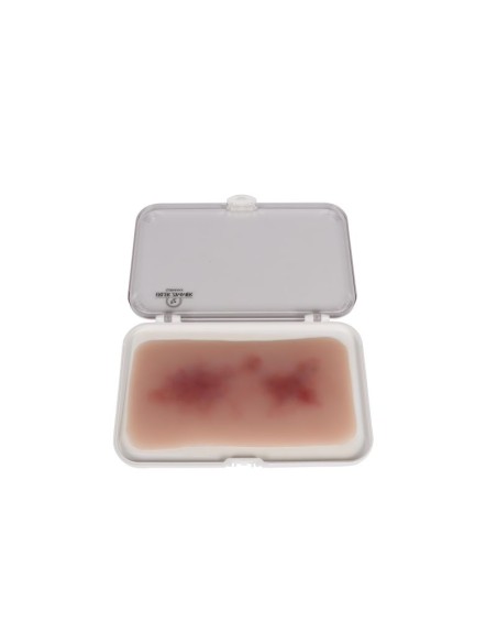 Erler Zimmer EZ-NW117 Moulage para heridas con hematoma fresco