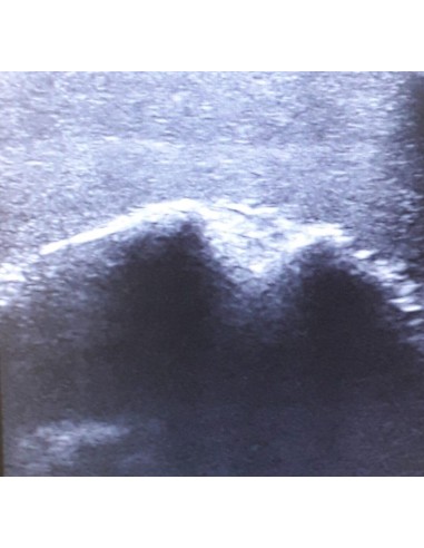 Simulador de ultrasonidos de la articulación del hombro SonoEZ