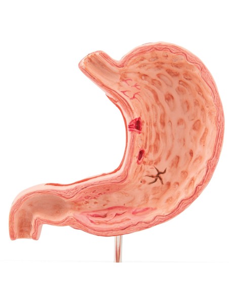 Modèle anatomique d'estomac présentant des ulcères gastriques, 3B Scientific K17