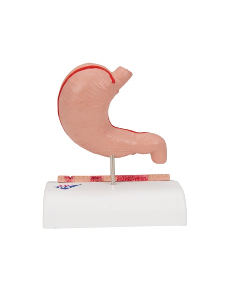 Anatomical Model of the Stomach with Gastric Ulcers by 3B Scientific K17