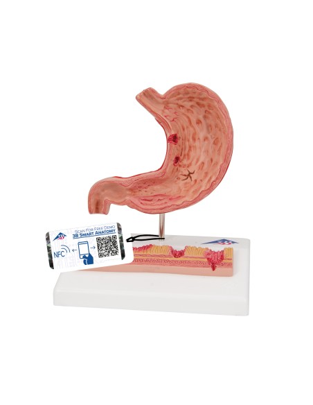 Anatomical Model of the Stomach with Gastric Ulcers by 3B Scientific K17