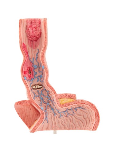 Modello anatomico di Malattie dell’esofago 3B Scientific K18