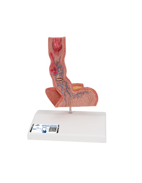 3B Scientific K18 Anatomical Model of Esophageal Diseases