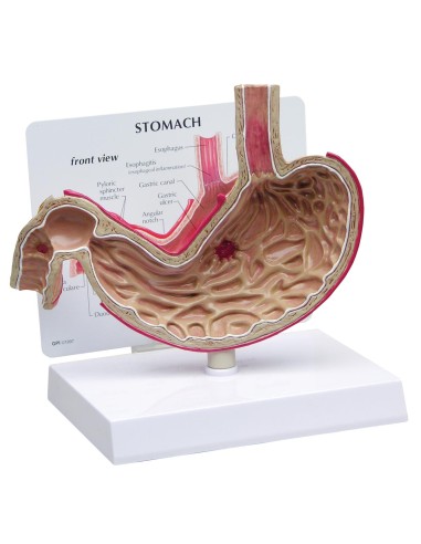 3B Scientific Stomach Model with Ulcers 1019523