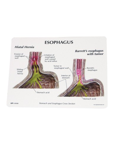 Modèle de reflux gastro-œsophagien 3B...
