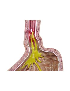 3B Scientific Gastroesophageal Reflux Model 1019525 2