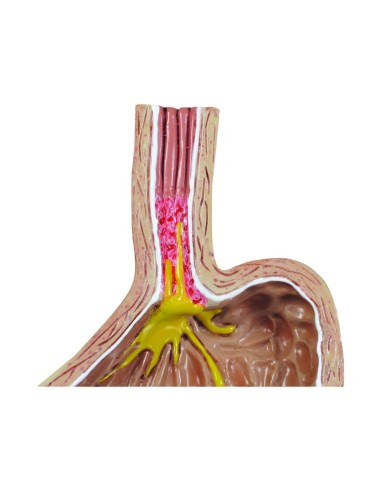 Modell für gastroösophagealen Reflux von 3B...