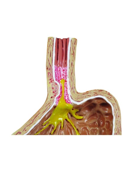 Modell für gastroösophagealen Reflux von 3B Scientific 1019525
