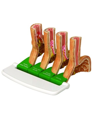Modell für gastroösophagealen Reflux von 3B...
