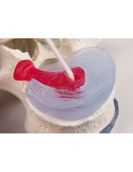 Erler Zimmer anatomical teaching model of 3 lumbar vertebrae with prolapse, on stand 4047