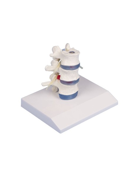 Erler Zimmer anatomical teaching model of 3 lumbar vertebrae with prolapse, on stand 4047