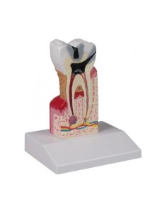 Erler Zimmer, modello anatomico di dente cariato,...