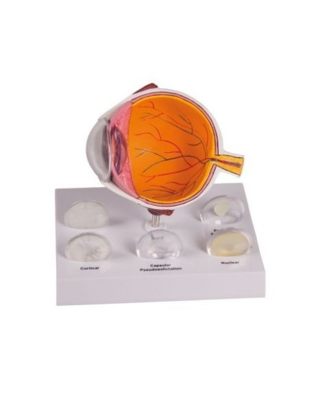 Erler Zimmer, anatomical model of 'eye with cataract, enlarged F80