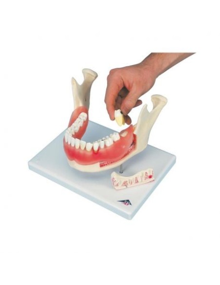 3B Scientific, modello anatomico di Patologie Dentali, ingrandito 2 volte, in 21 pezzi D26