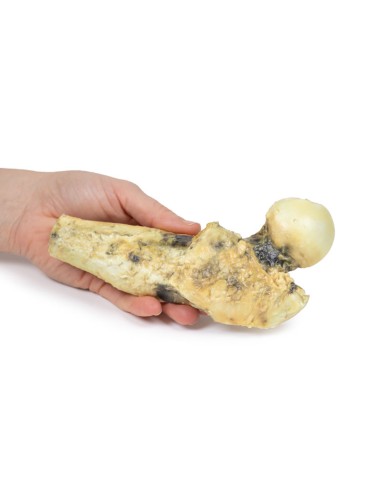 Osteosarcoma of the femur - Erler Zimmer 3D...