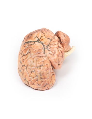 Craniofaringioma - Erler Zimmer 3D anatomy...