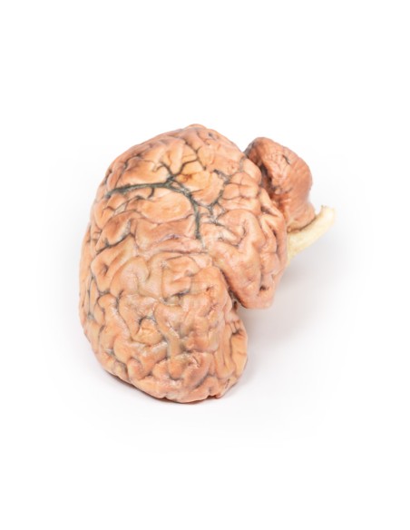 Craniofaringioma - Erler Zimmer 3D anatomy Series MP2017