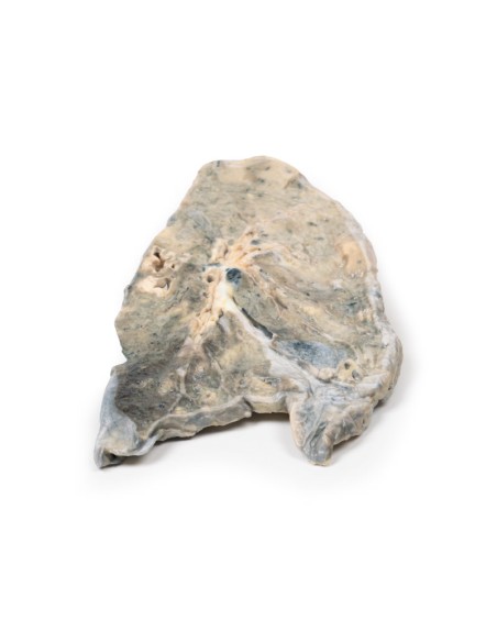 Polmone: ascesso da stafilococco aureo  - Erler Zimmer 3D anatomy Series MP2064