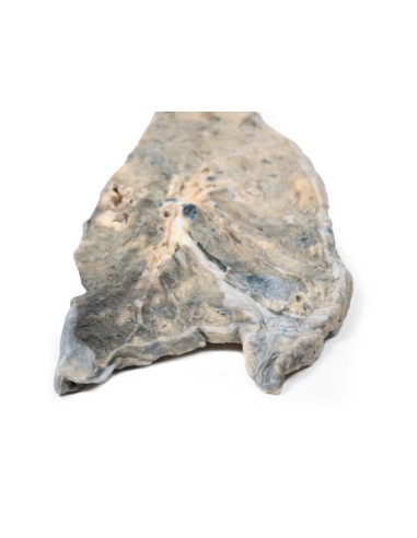 Poumon : abcès à staphylocoque doré - Erler...