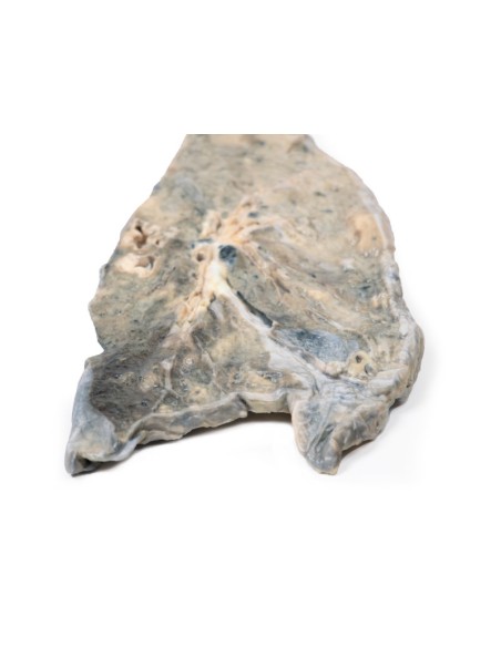 Polmone: ascesso da stafilococco aureo  - Erler Zimmer 3D anatomy Series MP2064