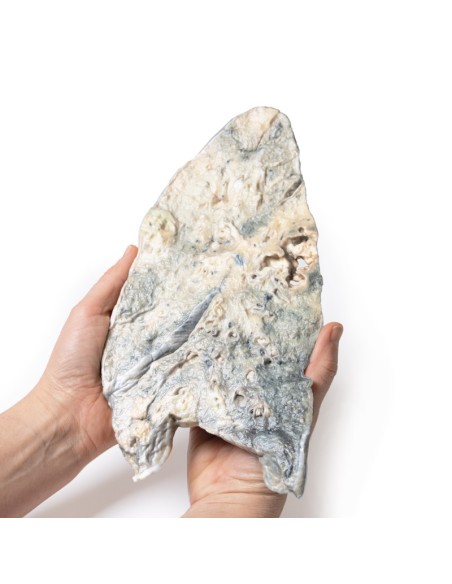 Lunge: Staphylococcus aureus Abszess - Erler Zimmer 3D Anatomie Serie MP2064