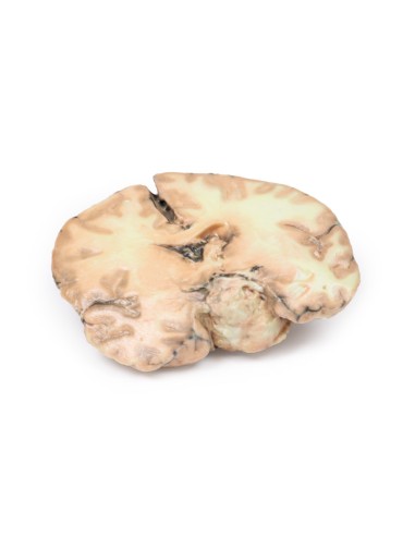 Glioblastome multiforme - Erler Zimmer 3D...