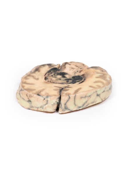 Glioblastoma multiforme - Erler Zimmer 3D anatomy Series MP2016