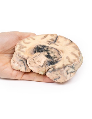 Glioblastoma multiforme - Erler Zimmer...