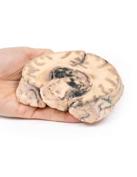 Glioblastoma multiforme - Erler Zimmer 3D-Anatomie Serie MP2016