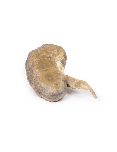 Multiple kidney stones - Erler Zimmer 3D...