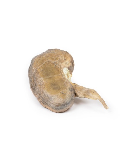Multiple kidney stones - Erler Zimmer 3D anatomy Series MP2095
