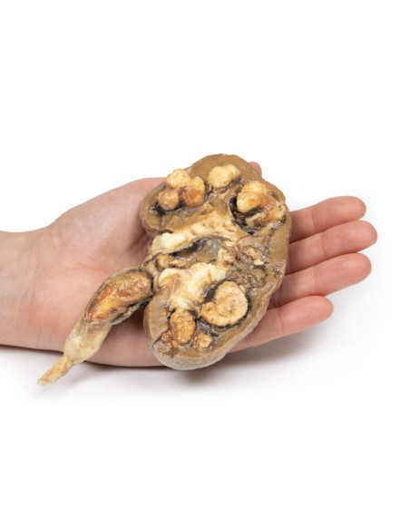 Multiple kidney stones - Erler Zimmer 3D anatomy Series MP2095