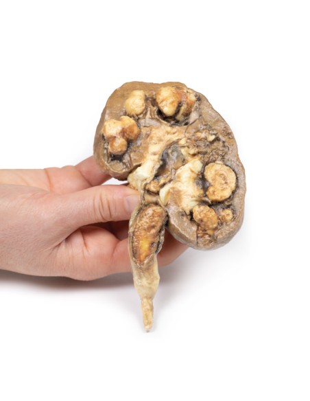 Multiple kidney stones - Erler Zimmer 3D anatomy Series MP2095