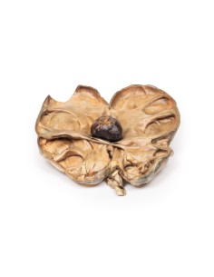 Hydronephrosis and hydroureter caused by obstruction by a...