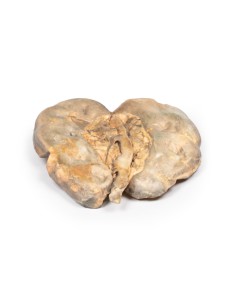 Hydronephrosis and hydroureter caused by obstruction by a... 2