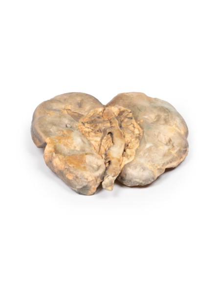Hydronephrosis and hydroureter caused by obstruction by a kidney stone - Erler Zimmer 3D anatomy Series MP2094