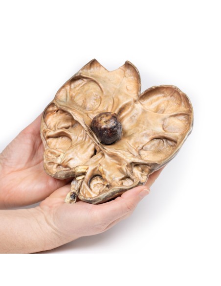 Hydronephrosis and hydroureter caused by obstruction by a kidney stone - Erler Zimmer 3D anatomy Series MP2094