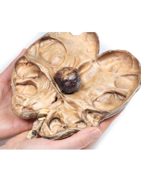 Hydronephrosis and hydroureter caused by obstruction by a kidney stone - Erler Zimmer 3D anatomy Series MP2094
