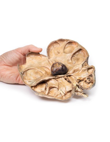 Hydronephrosis and hydroureter caused by...