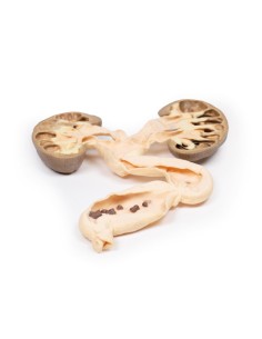 hydronephrosis and hydroureters - Erler Zimmer 3D anatomy...