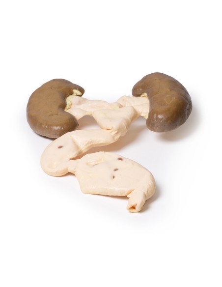 hydronephrosis and hydroureters - Erler Zimmer 3D anatomy Series MP2093