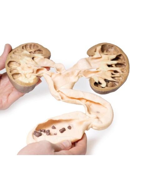 hydronephrosis and hydroureters - Erler Zimmer 3D anatomy Series MP2093