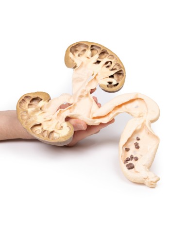 hydronephrosis and hydroureters - Erler Zimmer...