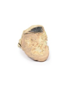 Adrenal hemorrhage/Waterhouse-Friderichsen syndrome -...