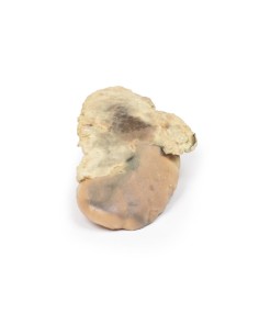 Adrenal hemorrhage/Waterhouse-Friderichsen syndrome -... 2