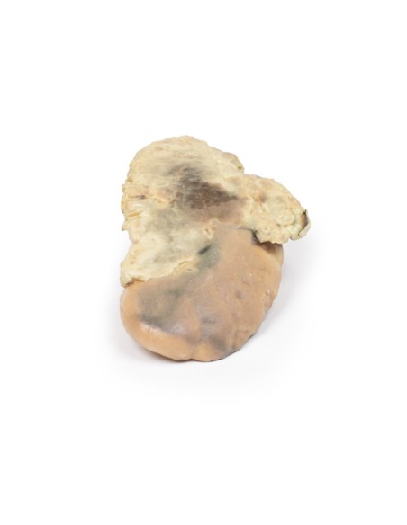 Adrenal hemorrhage/Waterhouse-Friderichsen syndrome - Erler Zimmer 3D anatomy Series MP2090