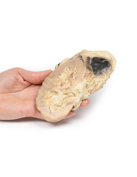 Adrenal hemorrhage/Waterhouse-Friderichsen syndrome - Erler Zimmer 3D anatomy Series MP2090