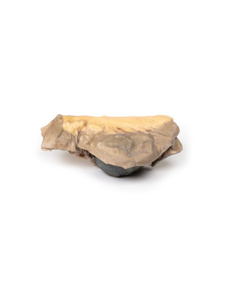 Ileo con calcoli  - Erler Zimmer 3D anatomy Series MP2078